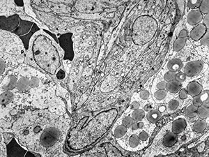 M,39y. | hemangioblastoma M,39y. | hemangioblastoma